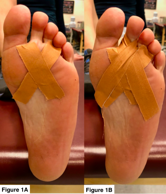 sesamoiditis taping