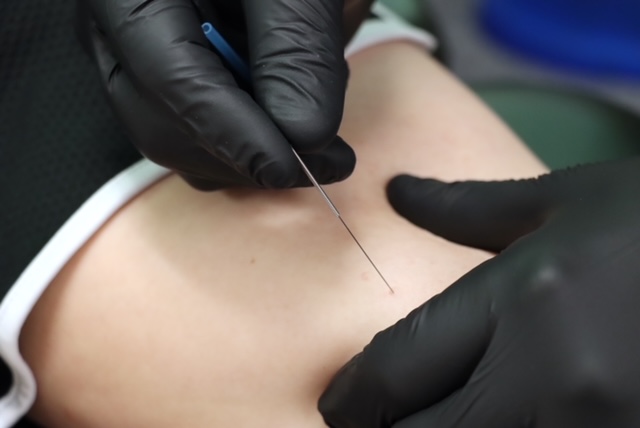 Dry needling / Ultrasound dry needling