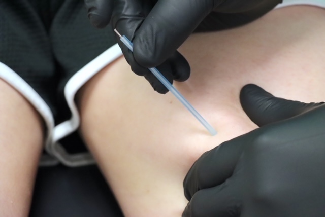 What is Dry Needling?  Preferred Physical Therapy