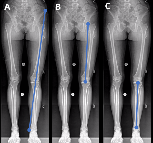 https://ijspt.scholasticahq.com/article/35704-femur-length-is-correlated-with-isometric-quadriceps-strength-in-post-operative-patients/attachment/90161.png