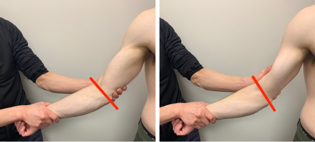 The Management Of Valgus Extension Overload Syndrome Experienced With 